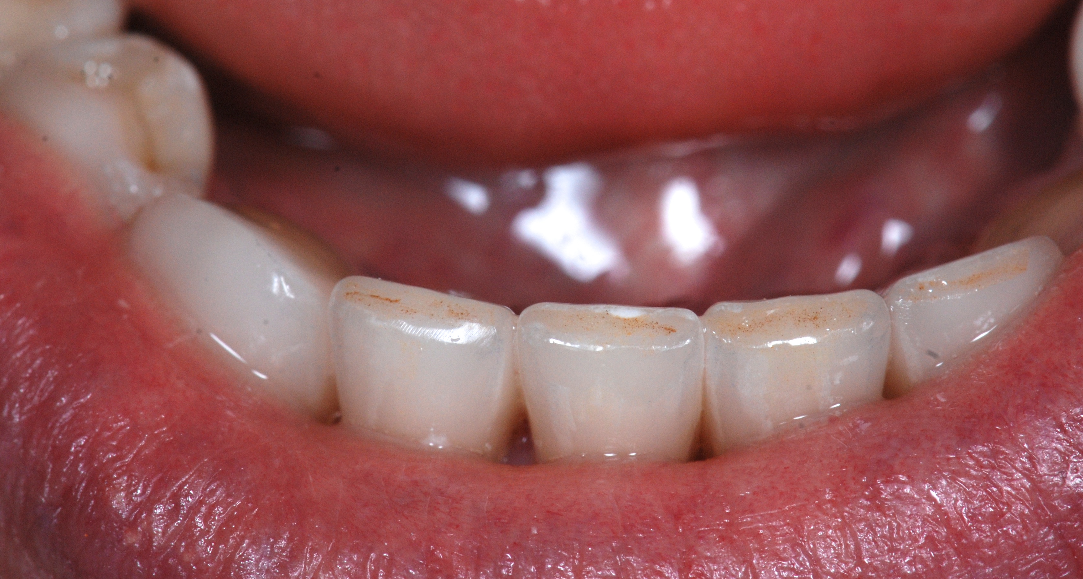 Lower Porcelain Crowns / Emax | Rick Glassman, DDS, MAAFE